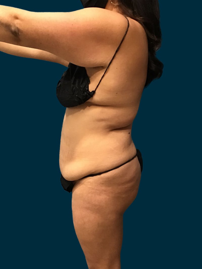 Patient LxjnEBgWT_yRzEA-nhO3bA - Tummy Tuck Before & After Photos