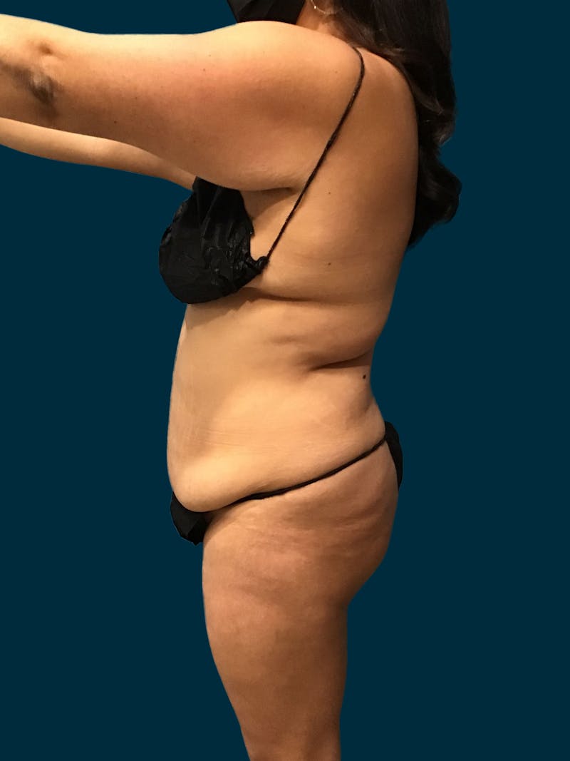 Liposuction Before & After Gallery - Patient 424806 - Image 5