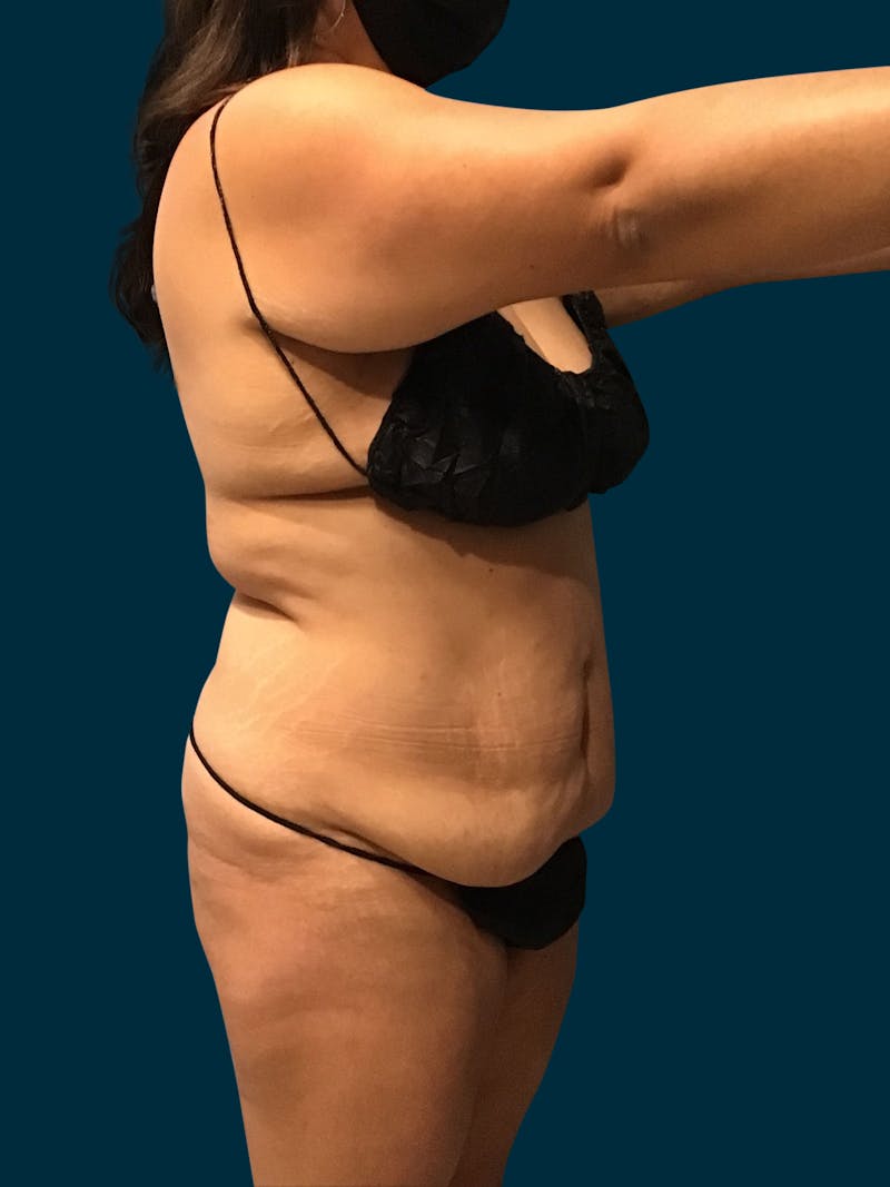 Liposuction Before & After Gallery - Patient 424806 - Image 1