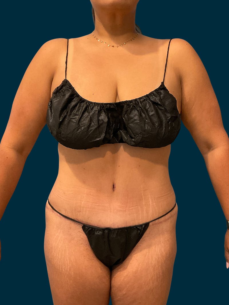 Liposuction Before & After Gallery - Patient 424806 - Image 4
