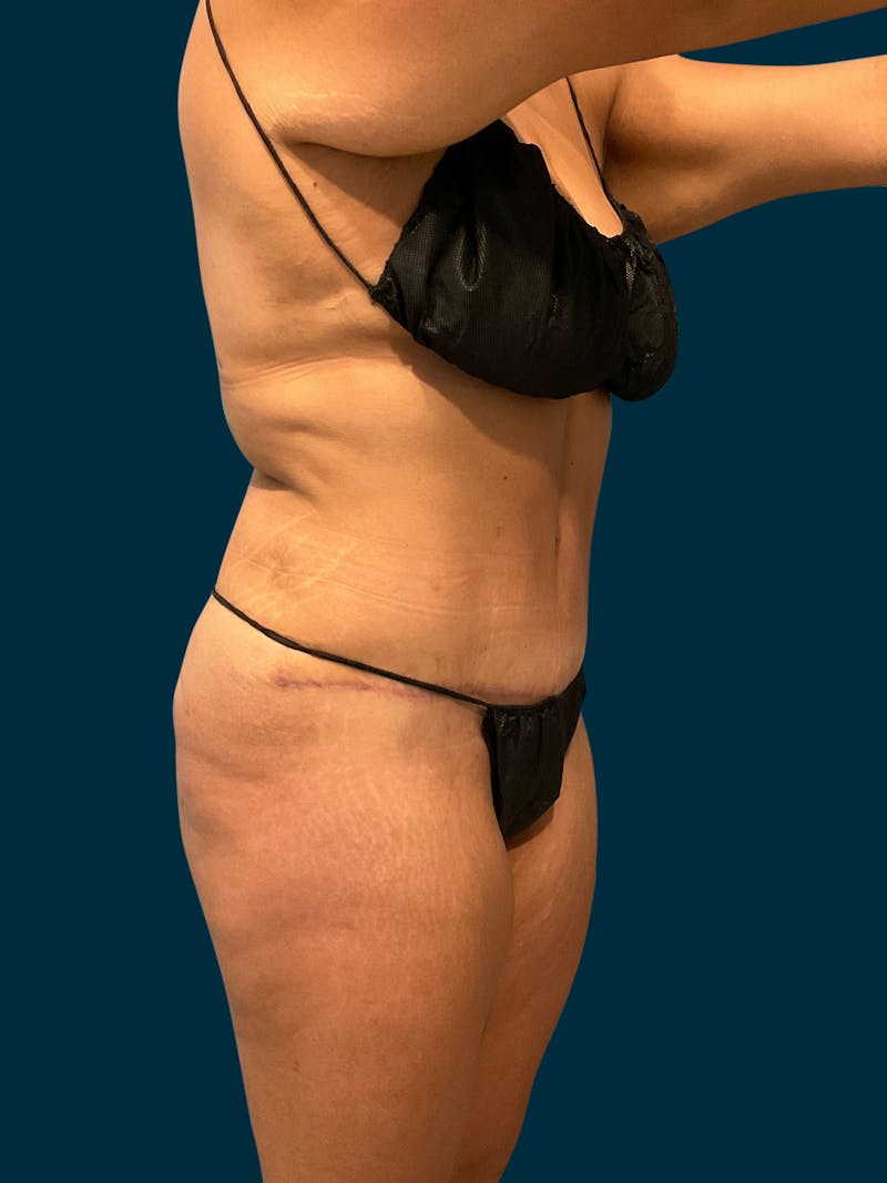 Liposuction Before & After Gallery - Patient 424806 - Image 2