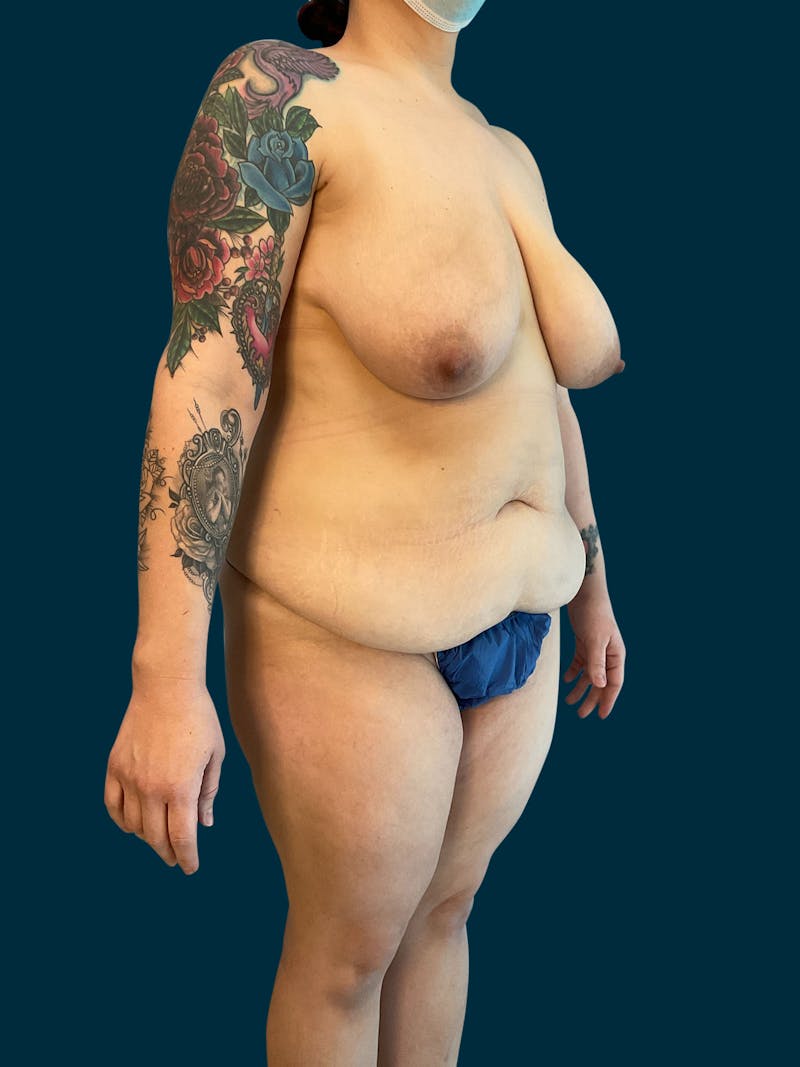 Abdominoplasty Before & After Gallery - Patient 316494 - Image 3