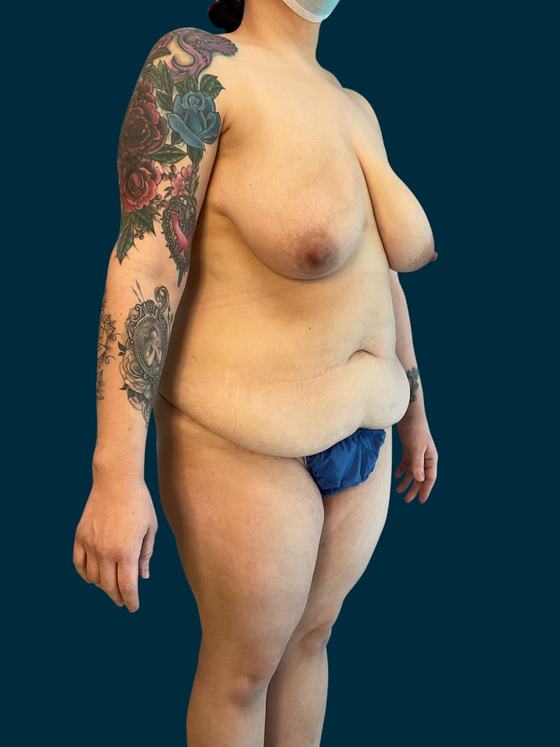 Liposuction Before & After Gallery - Patient 174445 - Image 3