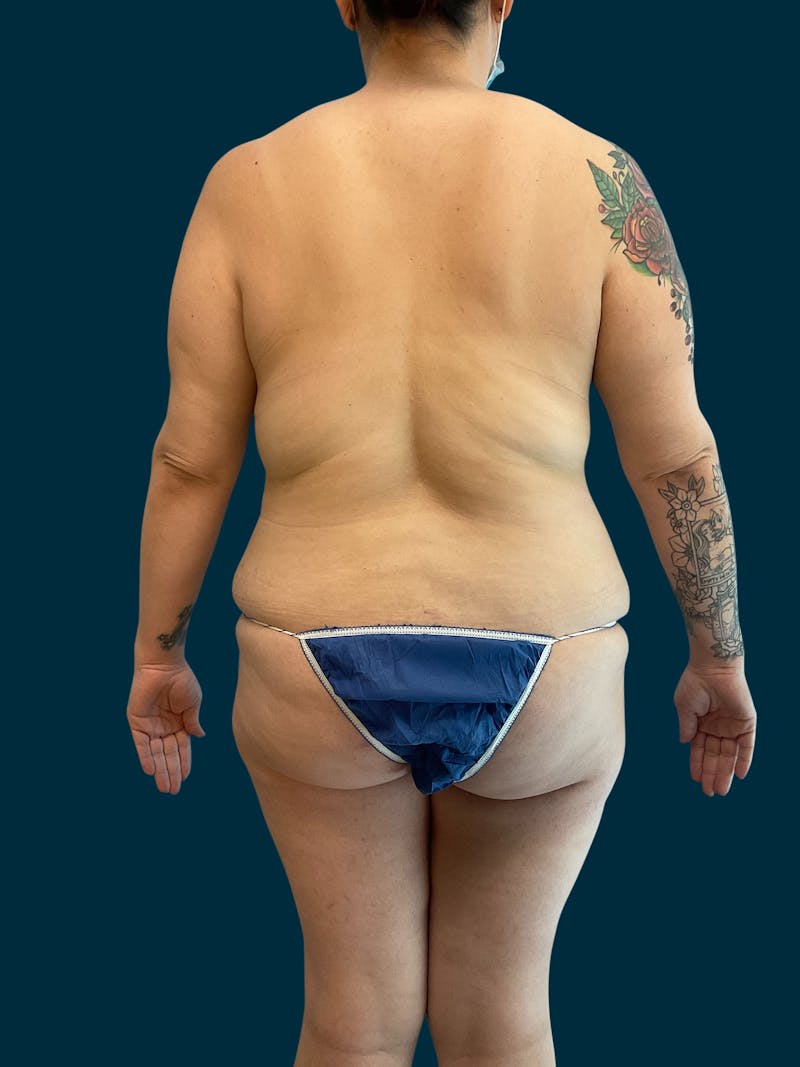 Liposuction Before & After Gallery - Patient 174445 - Image 7