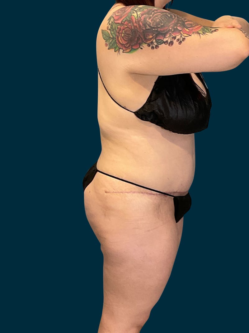 Abdominoplasty Before & After Gallery - Patient 316494 - Image 6