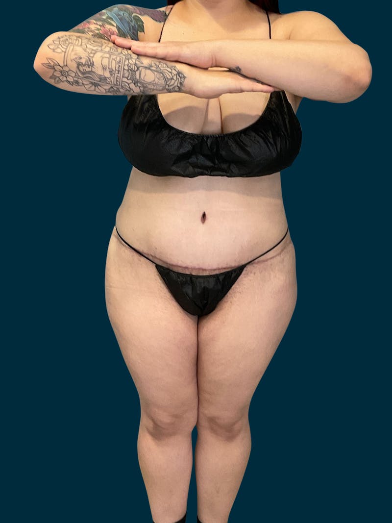 Abdominoplasty Before & After Gallery - Patient 316494 - Image 2