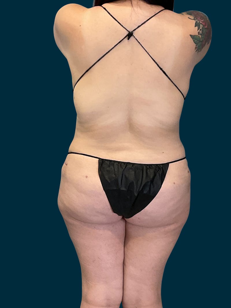 Liposuction Before & After Gallery - Patient 174445 - Image 8