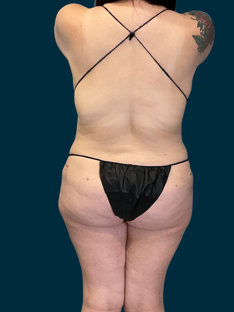 Liposuction Before & After Gallery - Patient 174445 - Image 8