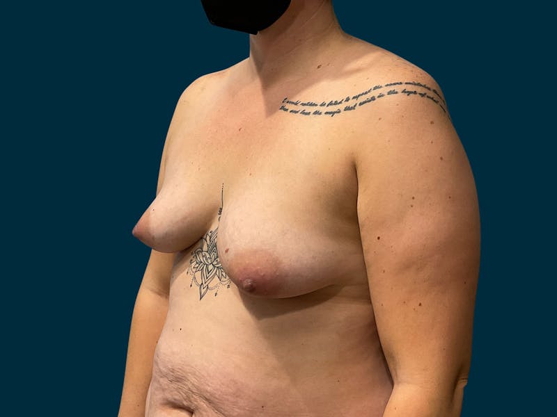 Breast Lift Before & After Gallery - Patient 363505 - Image 3
