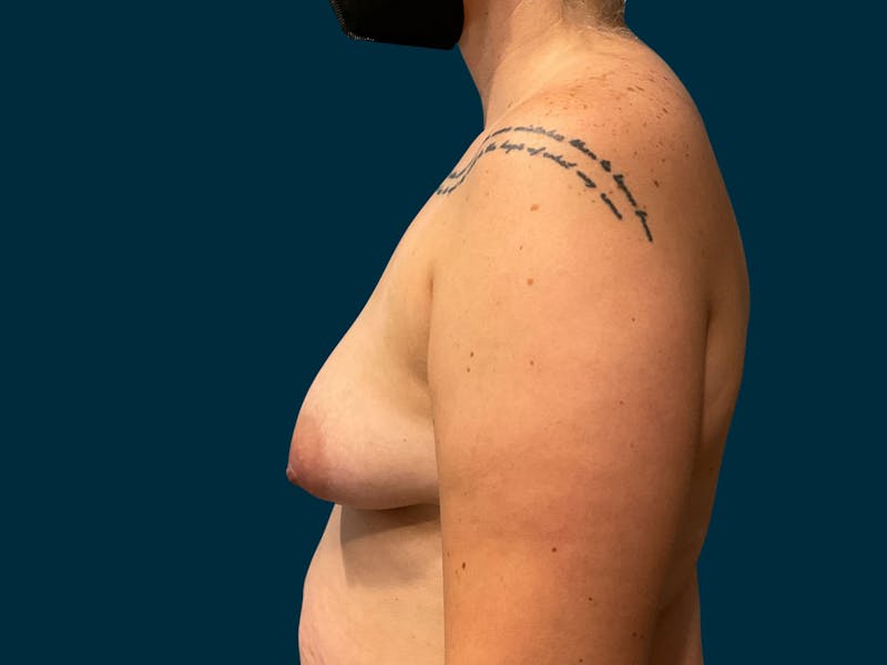 Breast Lift Before & After Gallery - Patient 363505 - Image 7