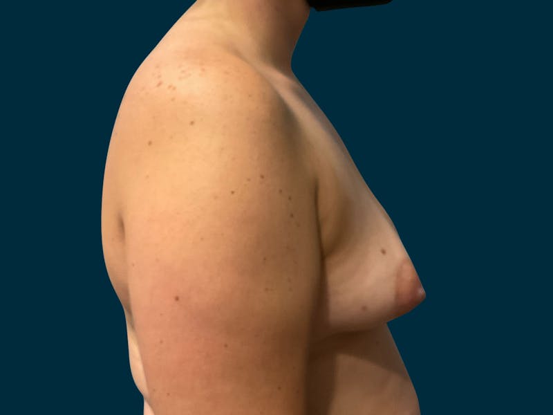 Breast Lift Before & After Gallery - Patient 363505 - Image 9