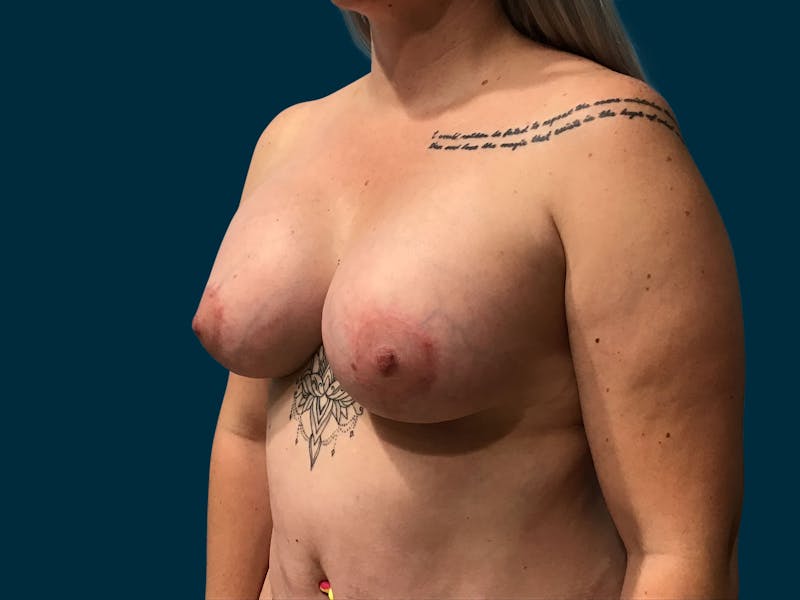 Breast Lift Before & After Gallery - Patient 363505 - Image 4