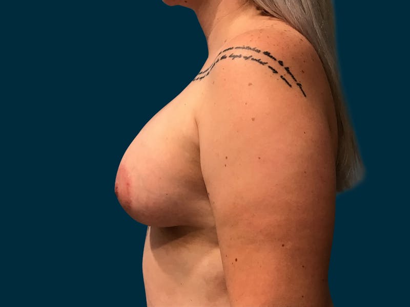 Breast Lift Before & After Gallery - Patient 363505 - Image 8