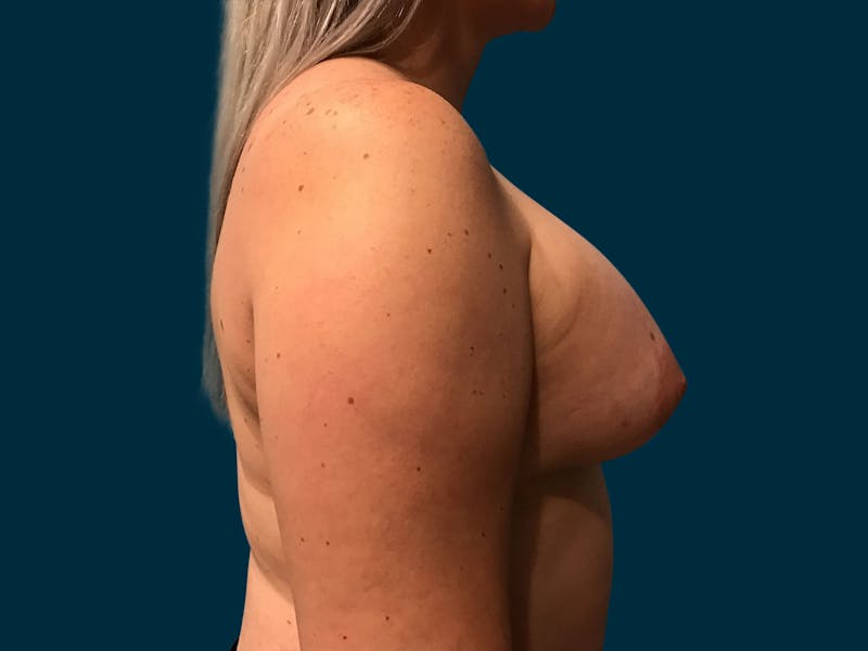 Breast Lift Before & After Gallery - Patient 363505 - Image 10