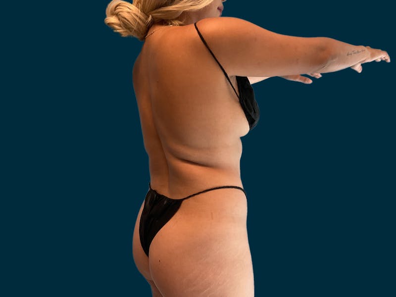 Liposuction Before & After Gallery - Patient 231379 - Image 5