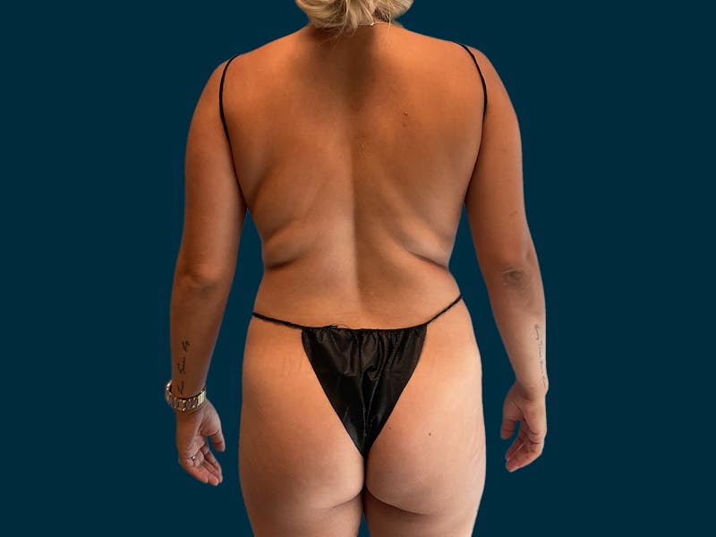 Patient sQFuNSMKQLCdJ9BkJk5PWw - Brazilian Butt Lift Before & After Photos