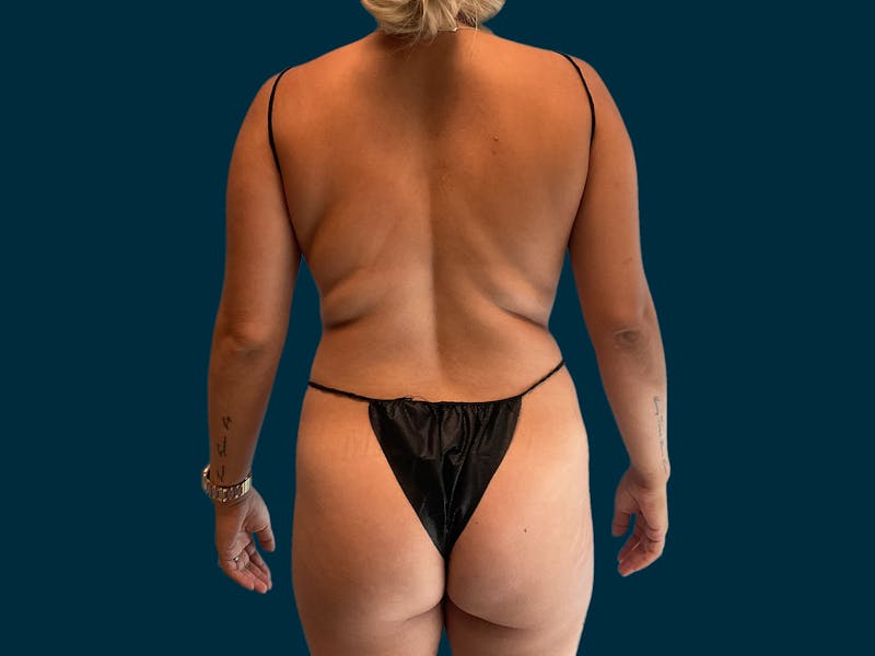 Brazilian Butt Lift in Fresno,CA  Athēnix Advanced Plastic Surgery