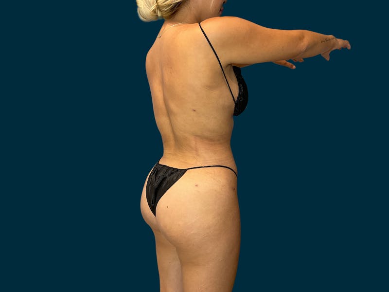 Liposuction Before & After Gallery - Patient 231379 - Image 6