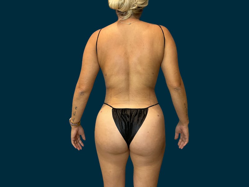 Brazilian Butt Lift in Fresno,CA  Athēnix Advanced Plastic Surgery