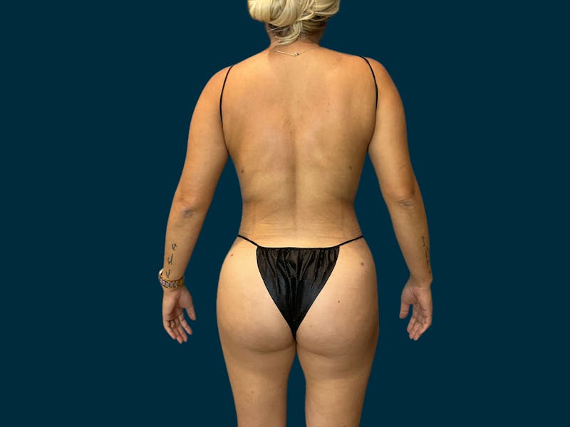 Liposuction Before & After Gallery - Patient 231379 - Image 8