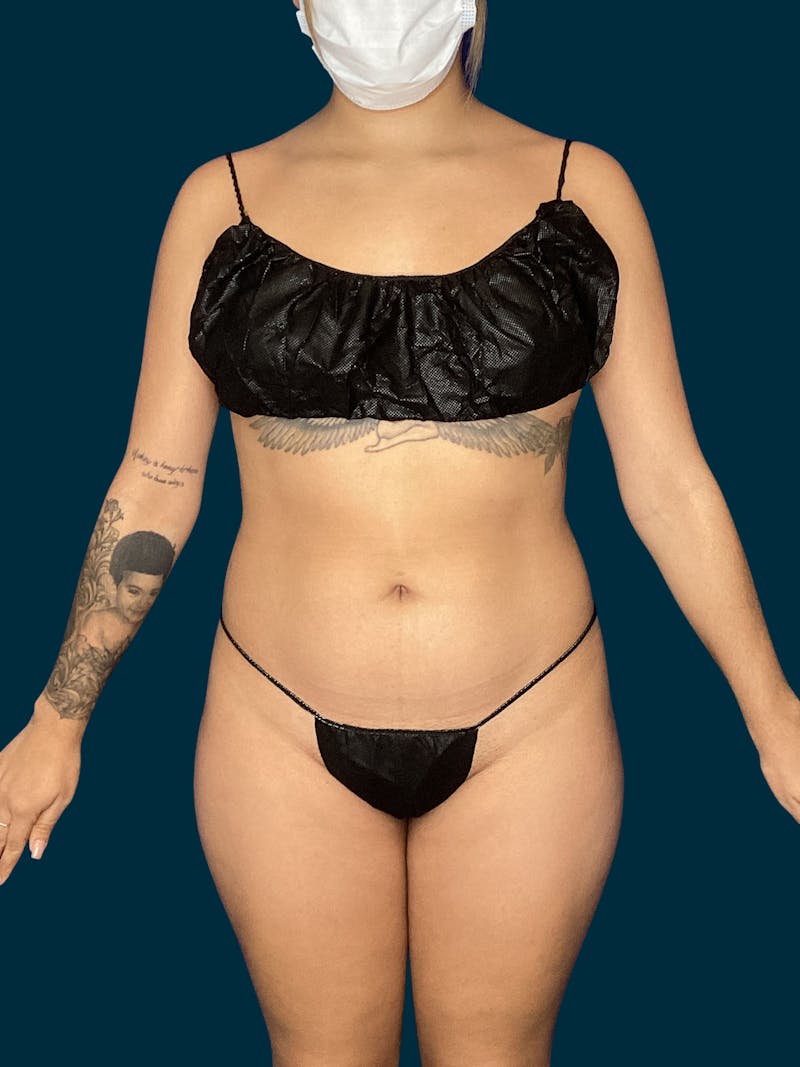 Liposuction Before & After Gallery - Patient 370566 - Image 1