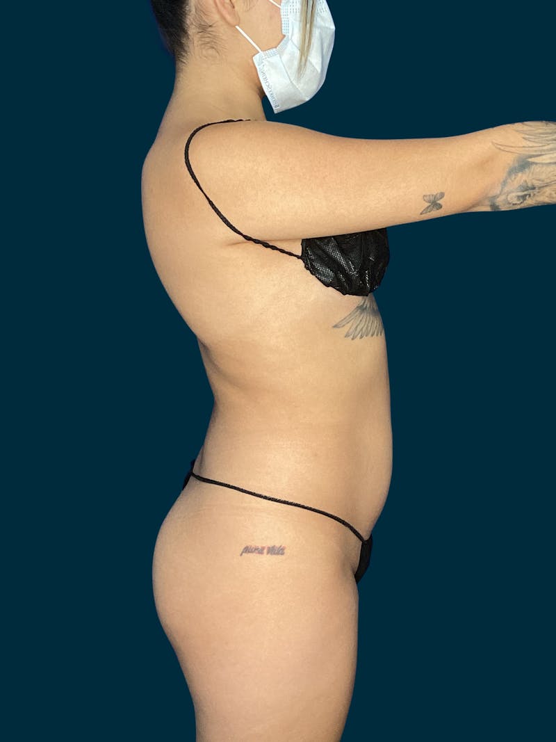 Liposuction Before & After Gallery - Patient 370566 - Image 7