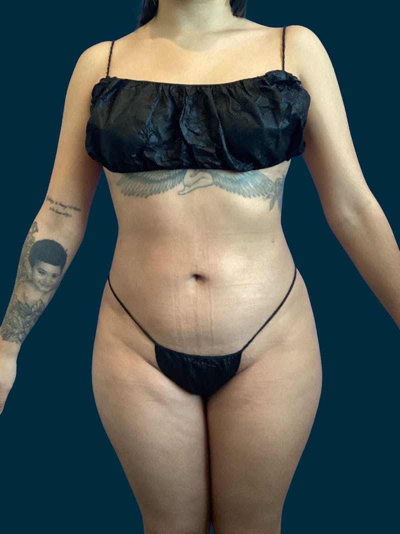 Liposuction Before & After Gallery - Patient 370566 - Image 2