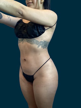 Liposuction Before & After Gallery - Patient 370566 - Image 4