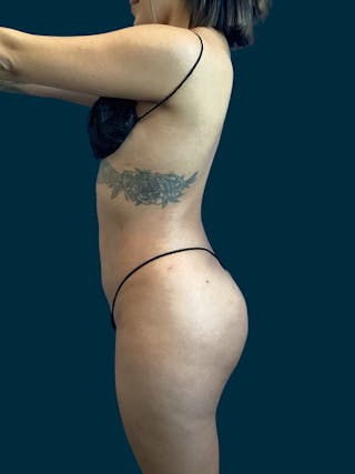 Liposuction Before & After Gallery - Patient 370566 - Image 6
