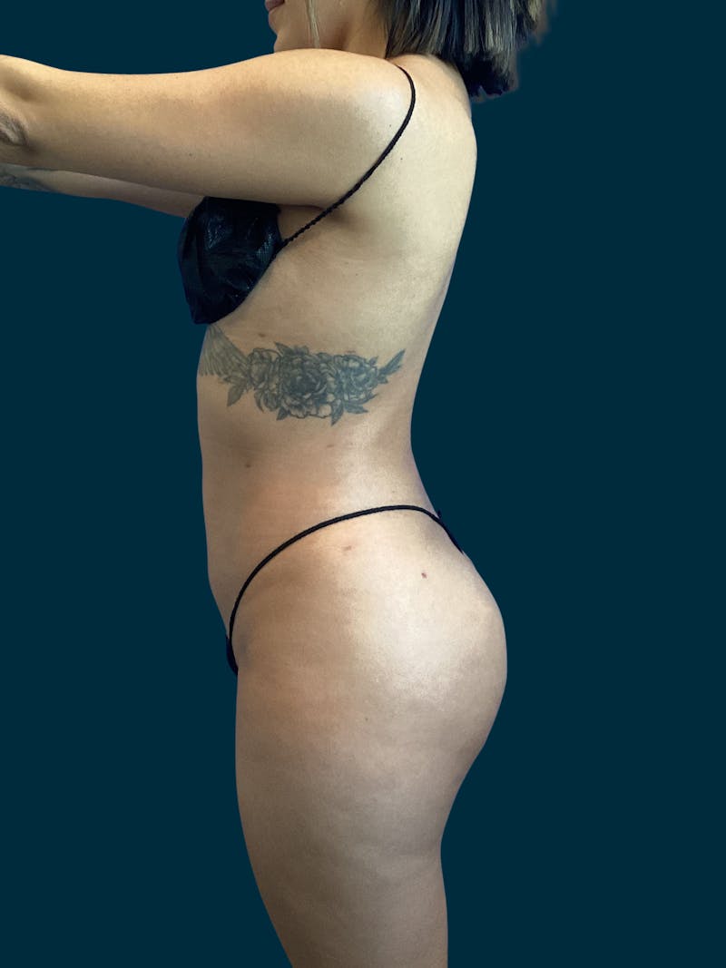 Liposuction Before & After Gallery - Patient 370566 - Image 6