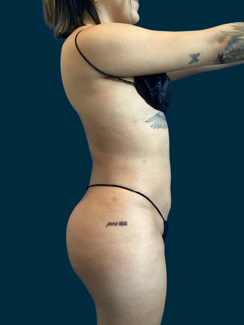 Liposuction Before & After Gallery - Patient 370566 - Image 8