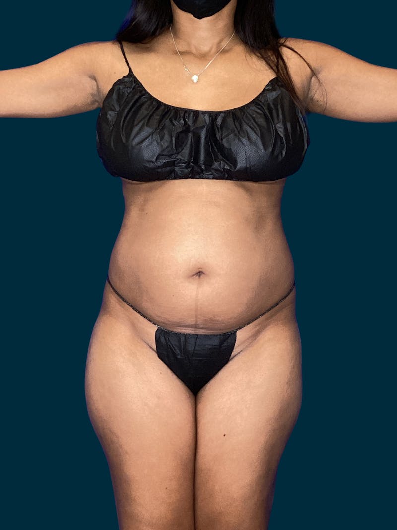 Liposuction Before & After Gallery - Patient 264395 - Image 5