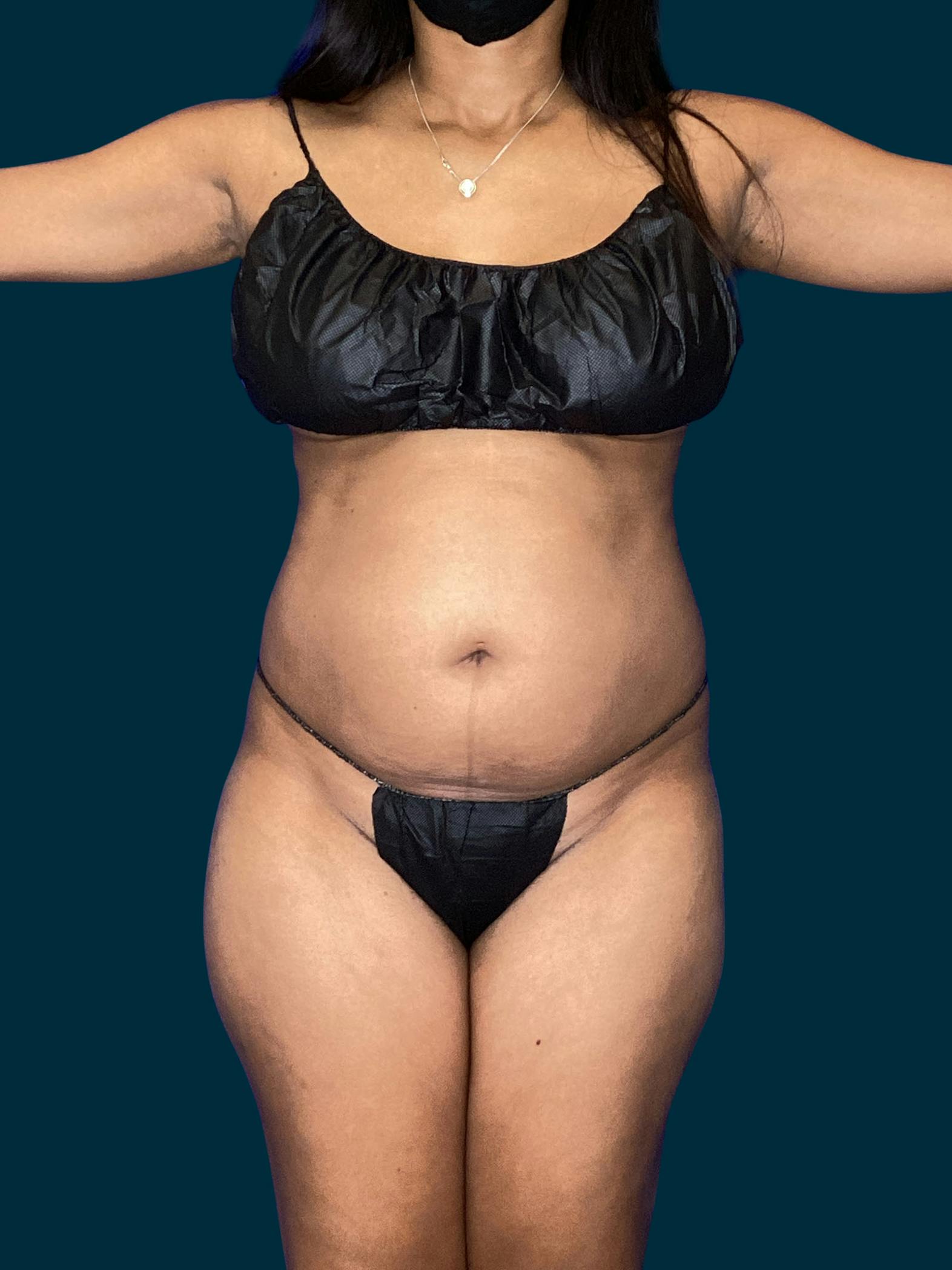 Tummy tuck patient before media