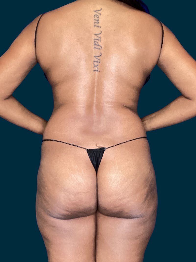 Liposuction Before & After Gallery - Patient 264395 - Image 3