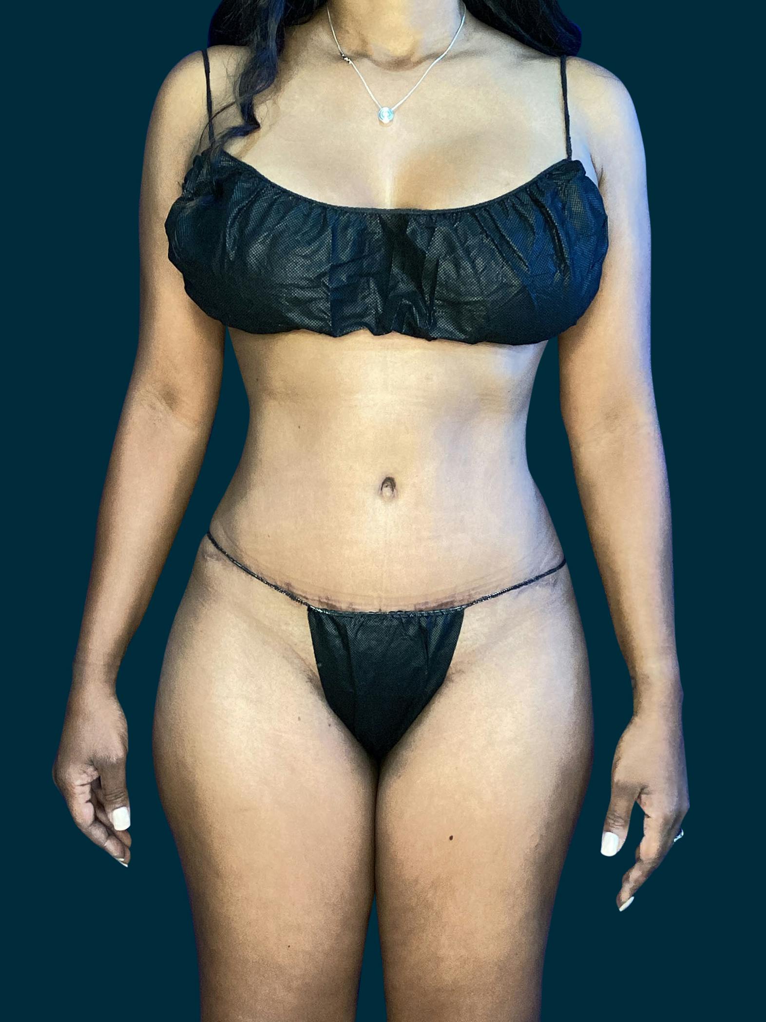 Tummy tuck patient before media