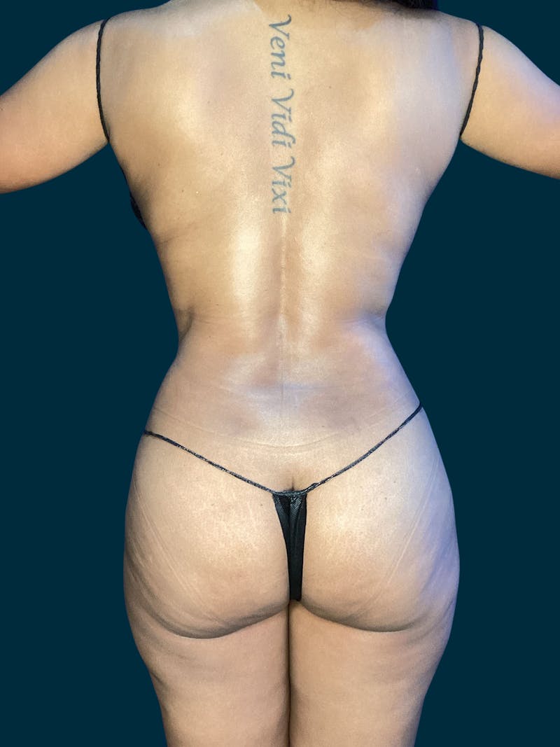 Liposuction Before & After Gallery - Patient 264395 - Image 4