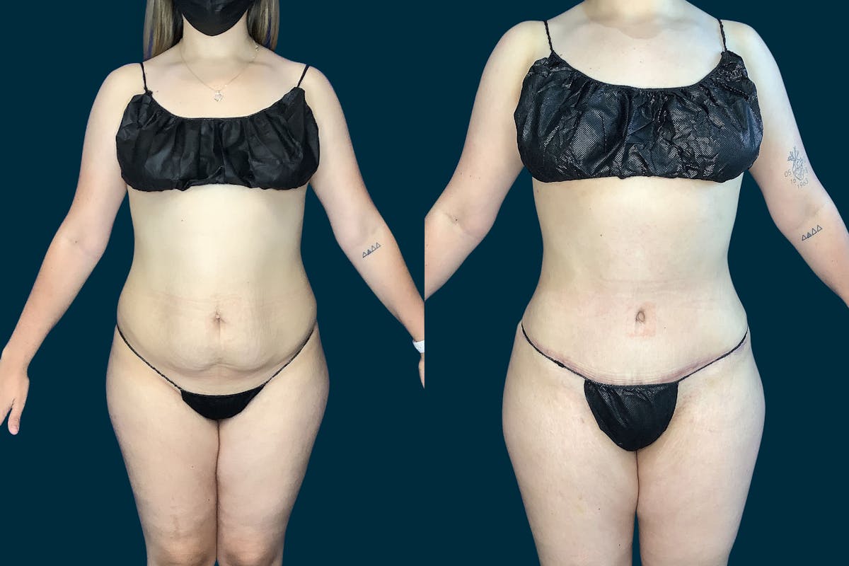 Liposuction Before & After Gallery - Patient 206484 - Image 3