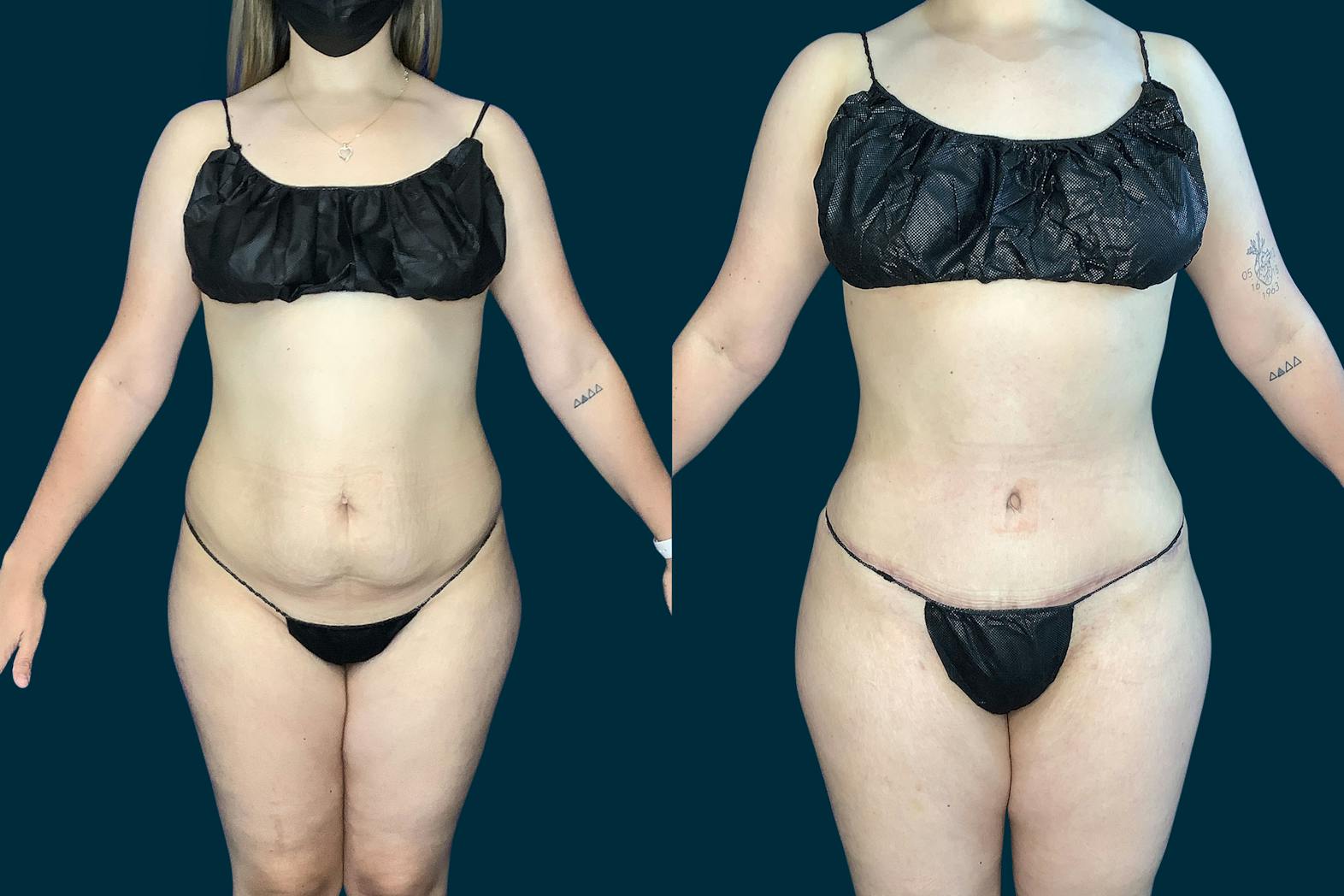 Arm lift patient before media