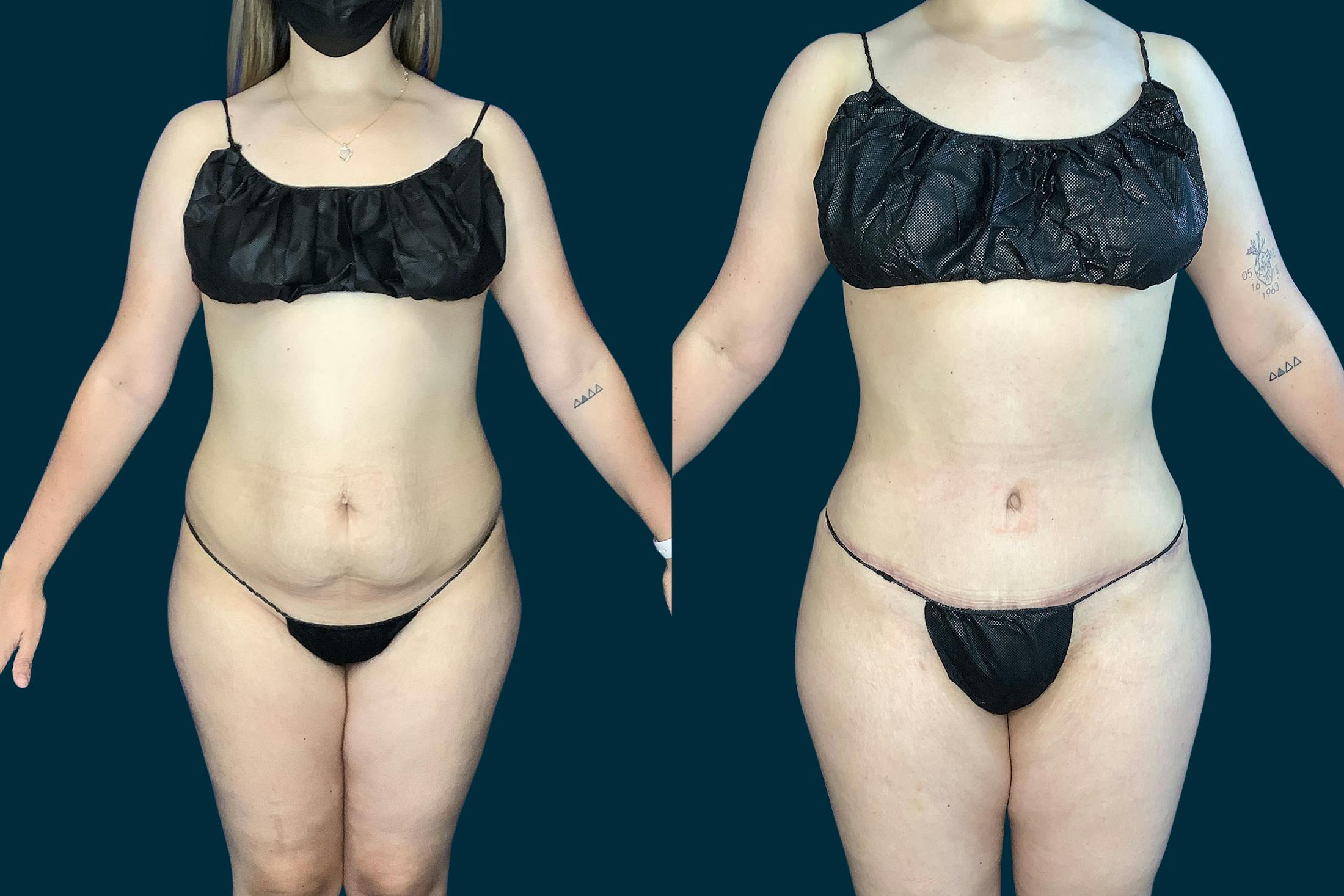 Fat Transfer Before & After Gallery - Patient 308397 - Image 3