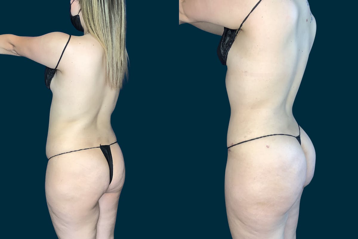 Liposuction Before & After Gallery - Patient 206484 - Image 1