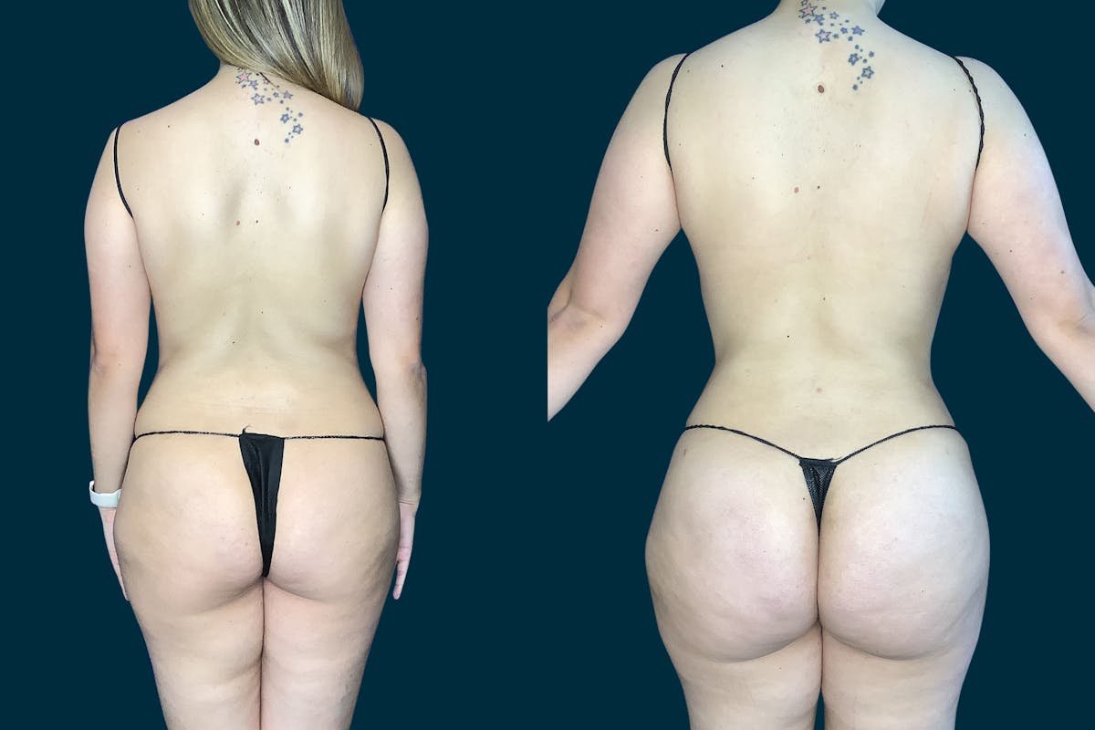 Liposuction Before & After Gallery - Patient 206484 - Image 2