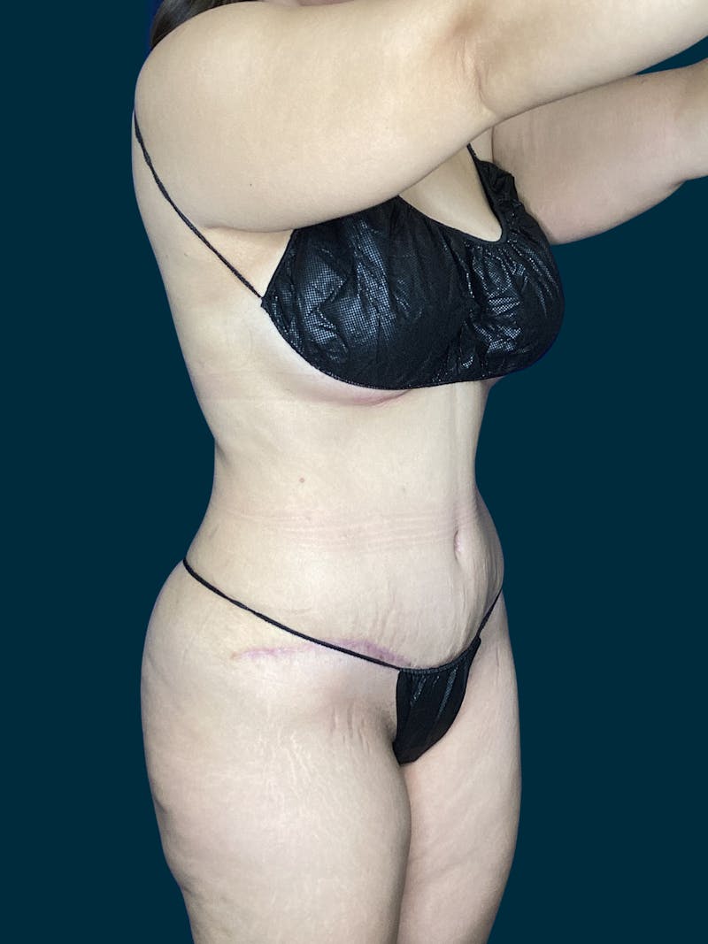 Abdominoplasty Before & After Gallery - Patient 269613 - Image 4