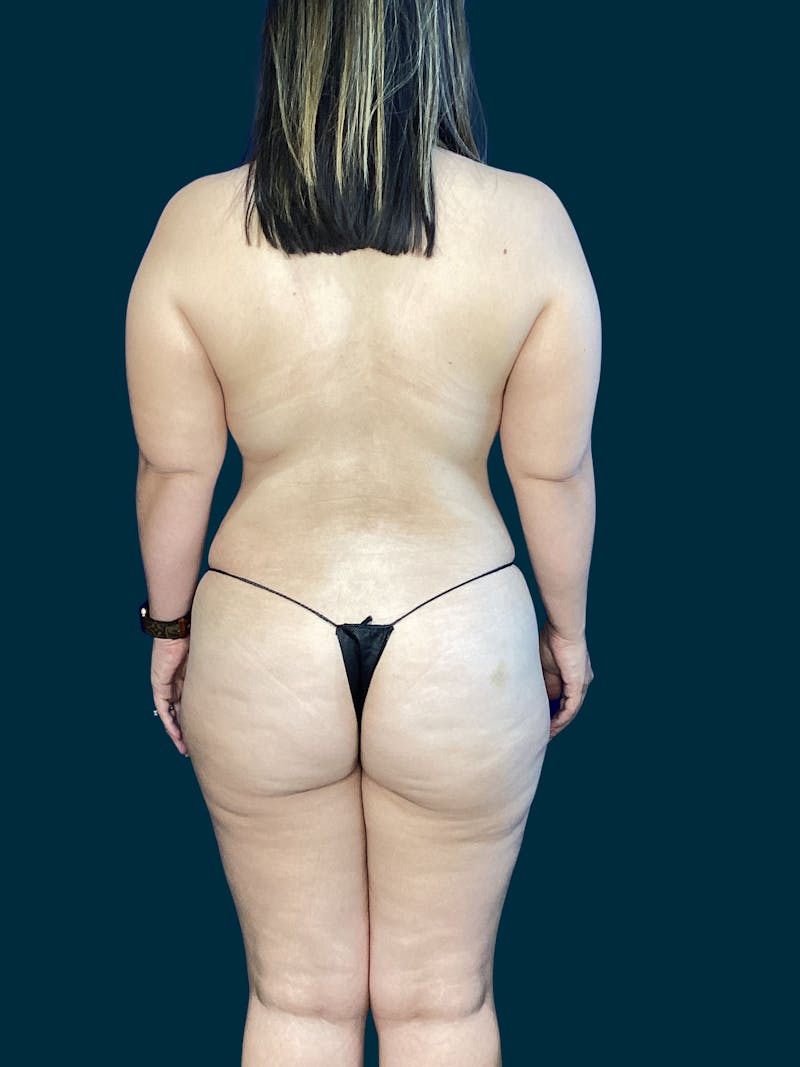 Liposuction Before & After Gallery - Patient 197043 - Image 3