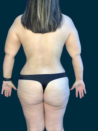 Liposuction Before & After Gallery - Patient 197043 - Image 4