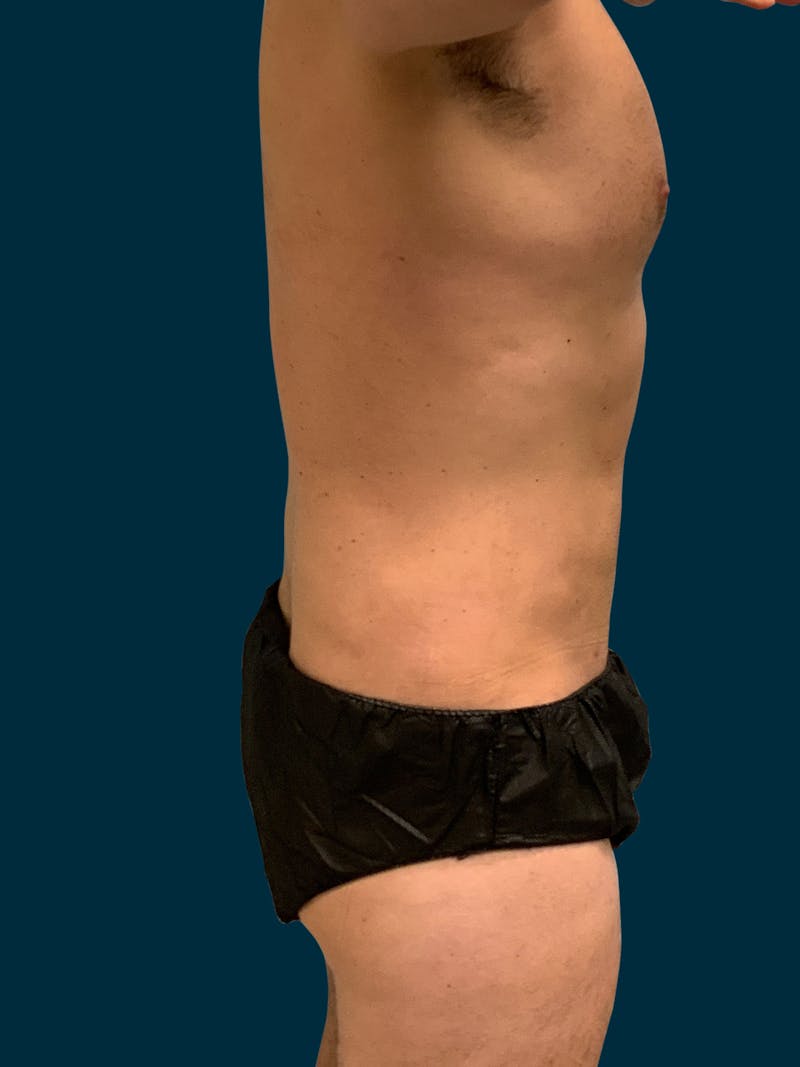 Liposuction Before & After Gallery - Patient 417909 - Image 6