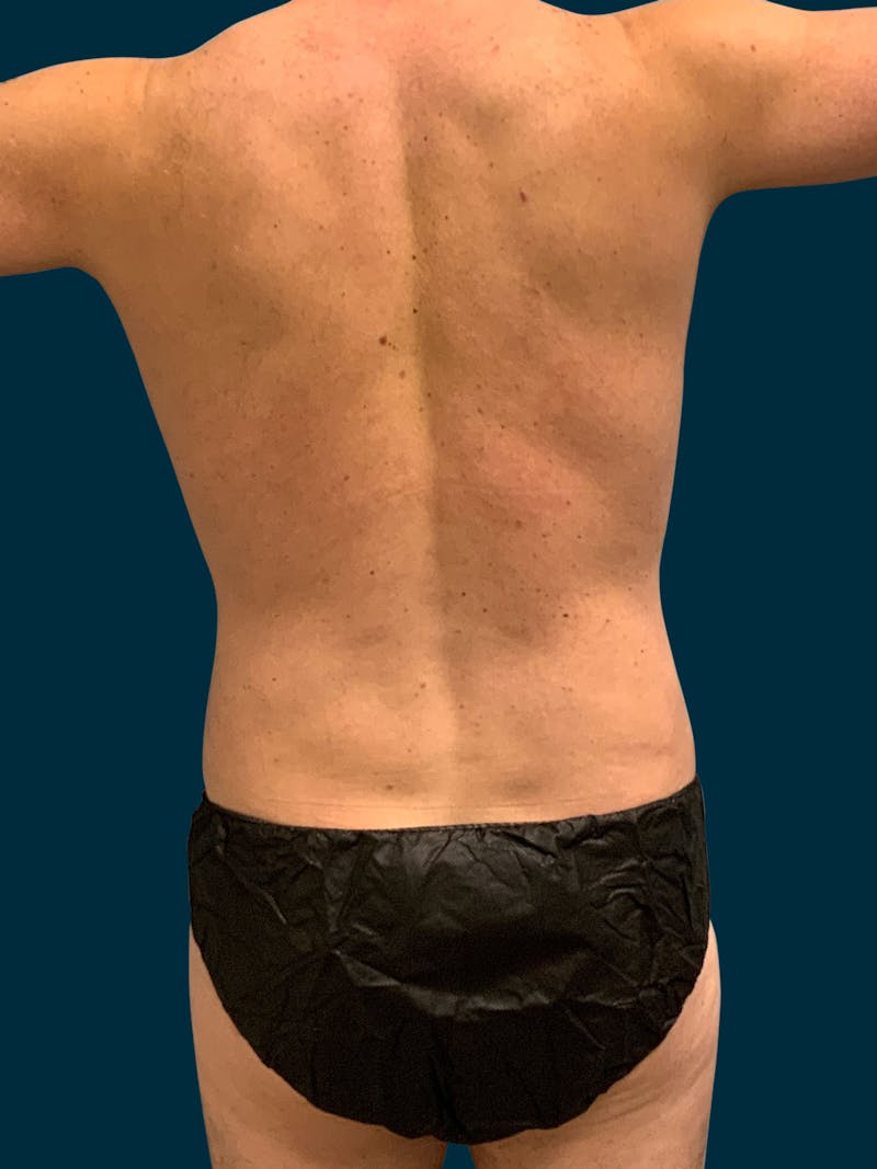 Liposuction Before & After Gallery - Patient 417909 - Image 8
