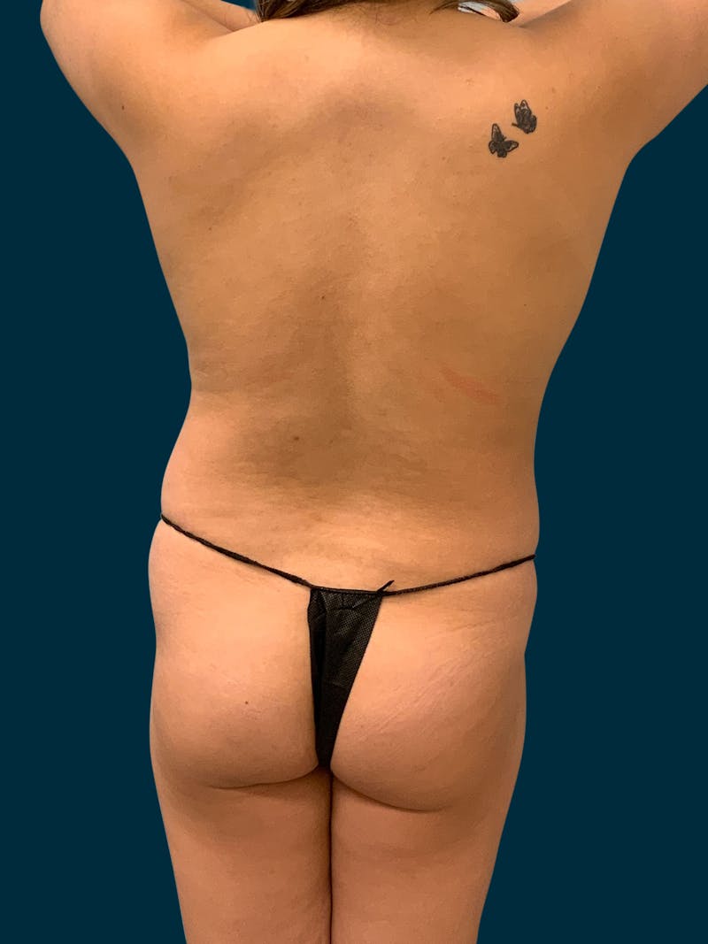 Liposuction Before & After Gallery - Patient 994468 - Image 7
