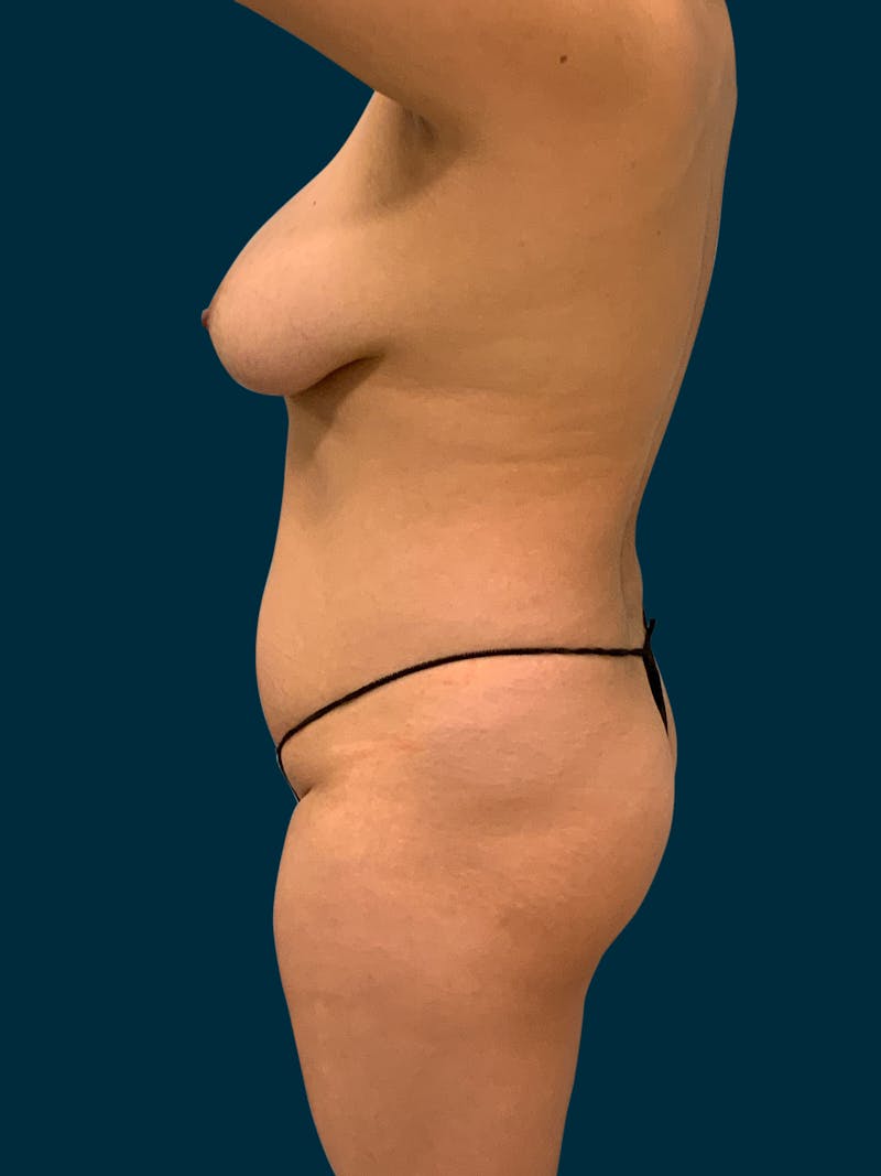 Liposuction Before & After Gallery - Patient 994468 - Image 9