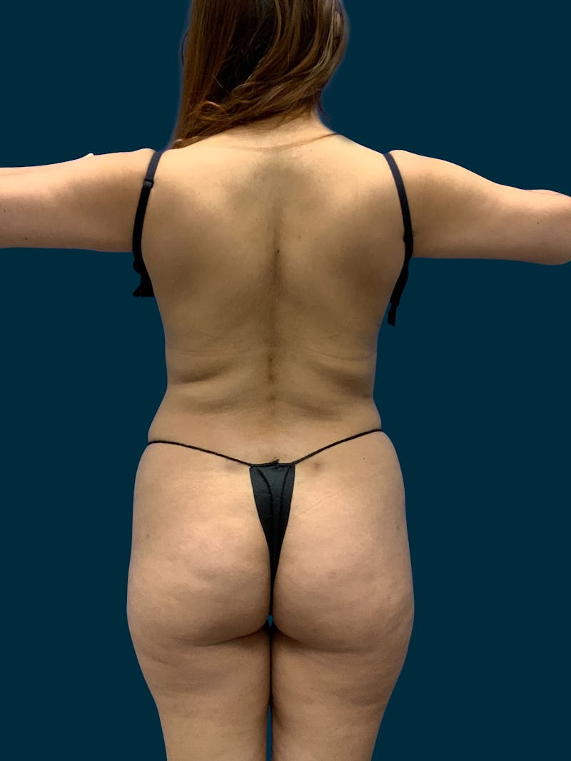Liposuction Before & After Gallery - Patient 308406 - Image 1