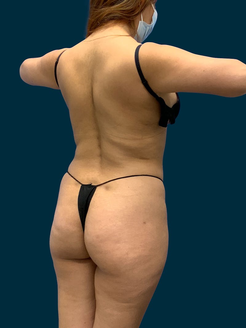 Fat Transfer Before & After Gallery - Patient 171522 - Image 3